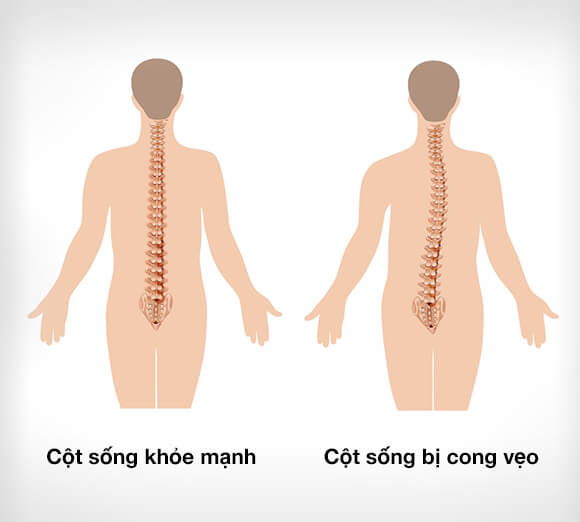 Cong vẹo cột sống