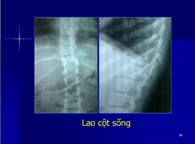 Hình ảnh X-quang lao cột sống