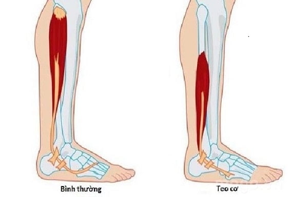 Thoát vị đĩa đệm cột sống cổ gây teo cơ, tàn phế Thoát vị đĩa đệm cột sống cổ gây teo cơ, tàn phế
