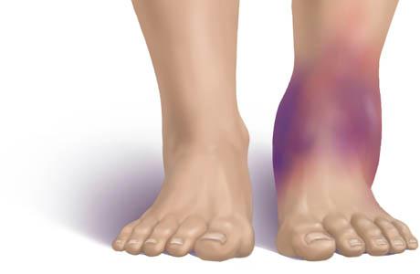 Viêm khớp cổ chân là gì?